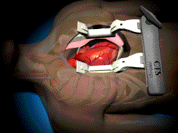 What Is Open Heart Surgery