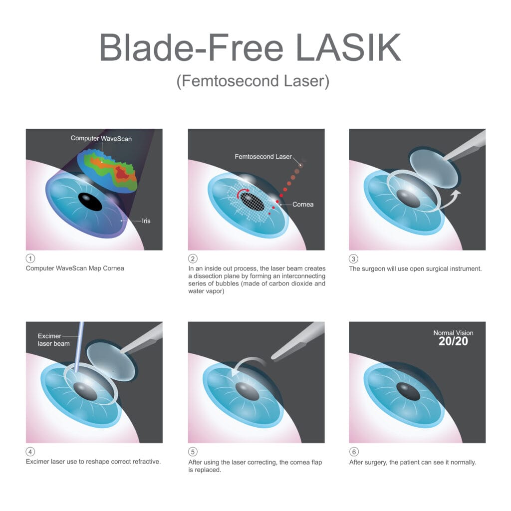 What is Advanced LASIK (Topography-Guided or Femtosecond LASIK)