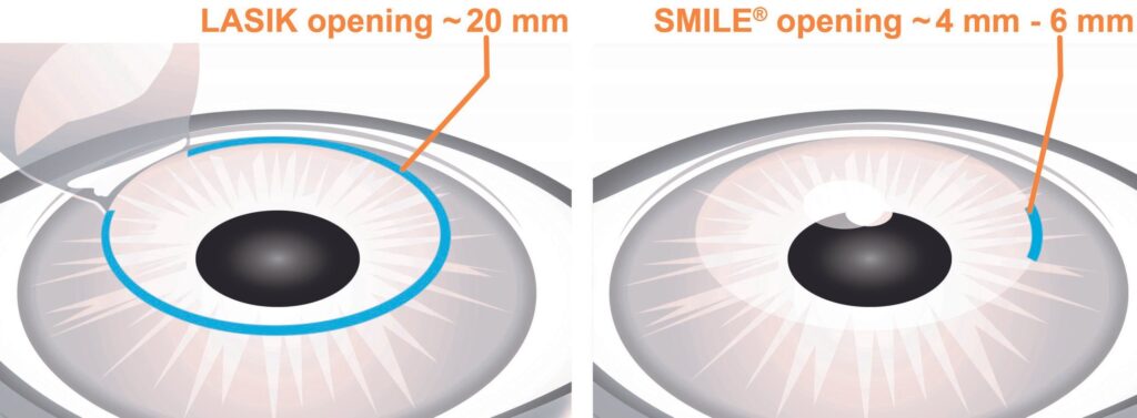 What is SMILE (Small Incision Lenticule Extraction)